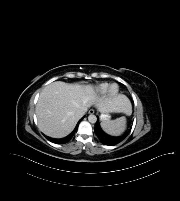 Anterior abdominal wall CSF pseudocyst (CSFoma) (Radiopaedia 79453-92571 A 16).jpg