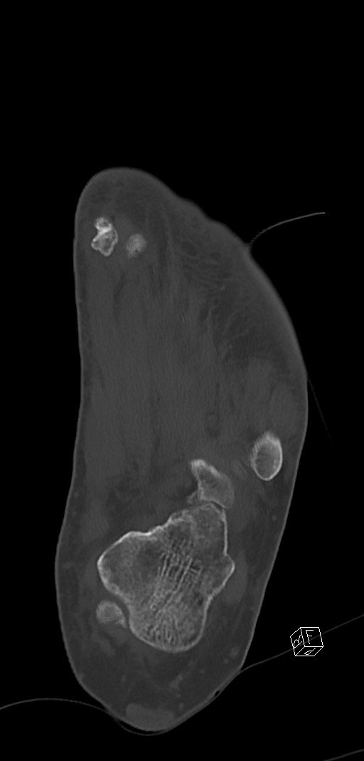 Anterior calcaneal process fracture (Radiopaedia 63353-71943 Coronal bone window 33).jpg