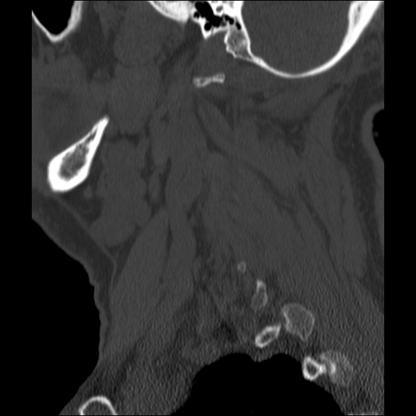 Anterior cervical postdiscectomy arthrodesis (Radiopaedia 32678-33646 Sagittal bone window 69).jpg