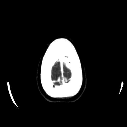 File:Anterior communicating artery aneurysm (Radiopaedia 16633-16335 A 42).jpg