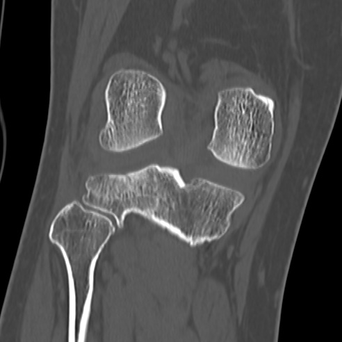 File:Anterior cruciate ligament avulsion fracture (Radiopaedia 58939-66194 Coronal bone window 23).jpg