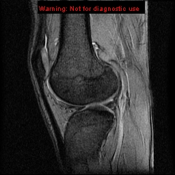 File:Anterior cruciate ligament injury - partial thickness tear (Radiopaedia 12176-12515 A 13).jpg