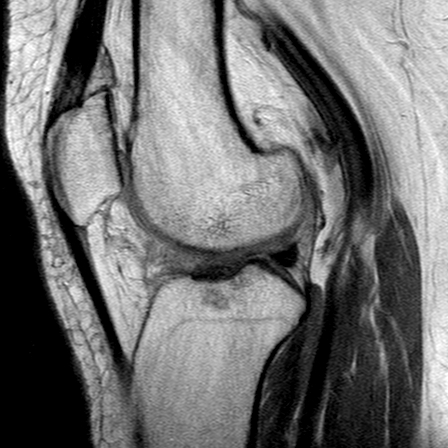 File:Anterior cruciate ligament mucoid degeneration (Radiopaedia 60853-68633 Sagittal PD 19).jpg