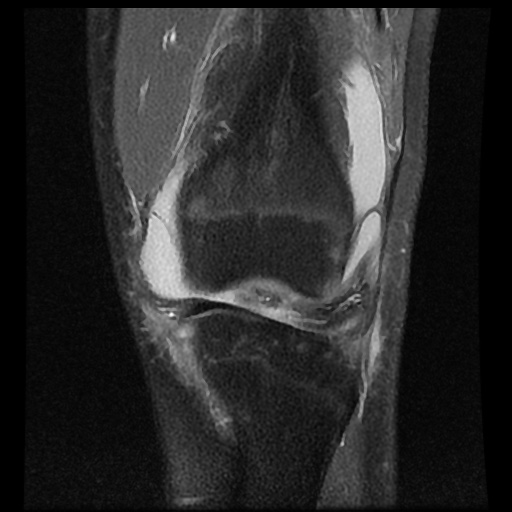 File:Anterior cruciate ligament tear (Radiopaedia 61500-69462 Coronal PD fat sat 7).jpg