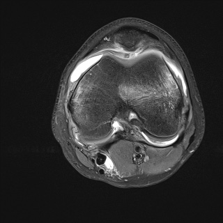 File:Anterior cruciate ligament tear - pediatric (Radiopaedia 62152-70260 Axial PD fat sat 18).jpg