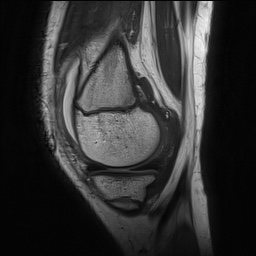 Anterior cruciate ligament tear - pediatric (Radiopaedia 62152-70260 Sagittal PD 46).jpg