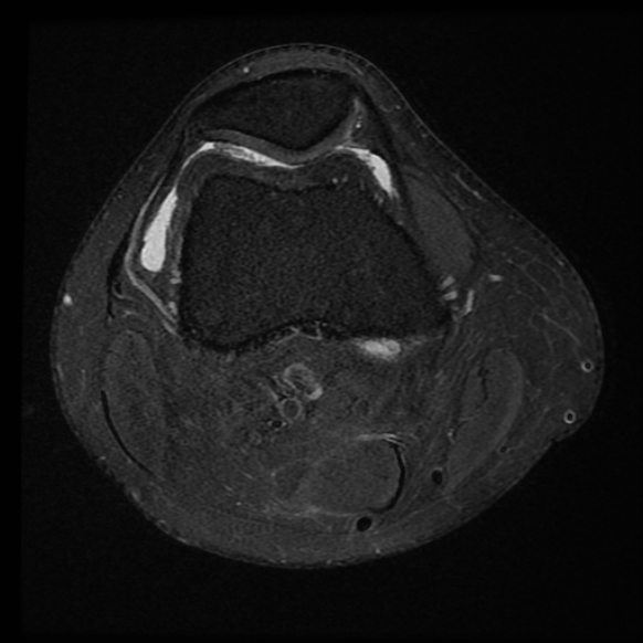 File:Anterior cruciate ligament tear with posteromedial corner injury, bucket-handle meniscal tear and chondral delamination (Radiopaedia 75501-86744 Axial PD fat sat 21).jpg