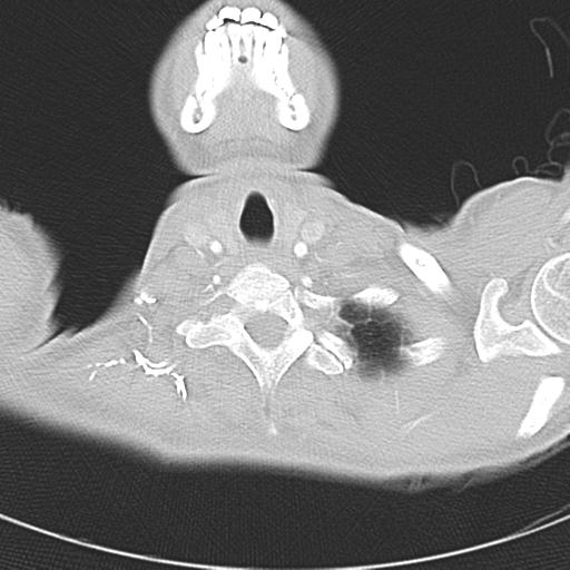 Anterior mediastinal lymphoma (Radiopaedia 29556-30061 Axial lung window 3).jpg