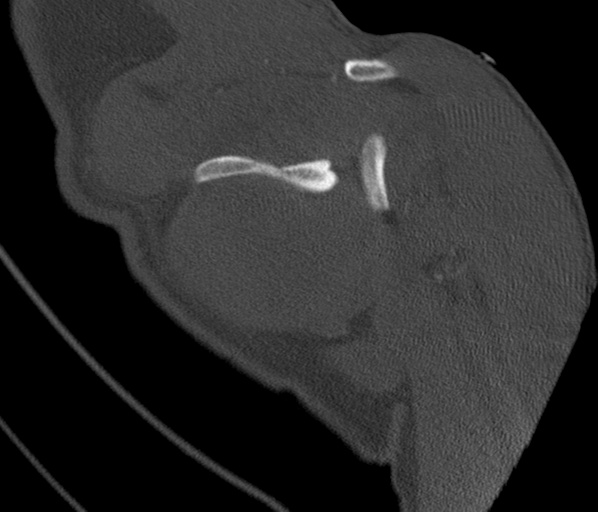 Anterior shoulder dislocation with Hill-Sachs and bony Bankart lesions (Radiopaedia 40424-42974 Coronal bone window 34).png