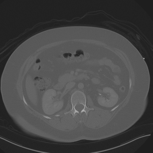 Anterior superior iliac spine avulsion fracture (Radiopaedia 44541-48244 Axial bone window 40).png