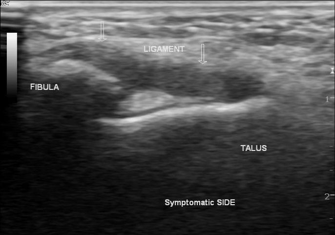 File:Anterior talofibular ligament injury (Radiopaedia 40411).jpg