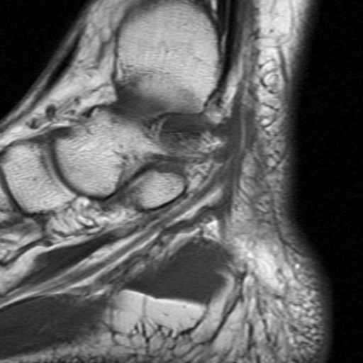 File:Anterior talofibular ligament rupture (Radiopaedia 15831-15484 Sagittal T1 15).jpg