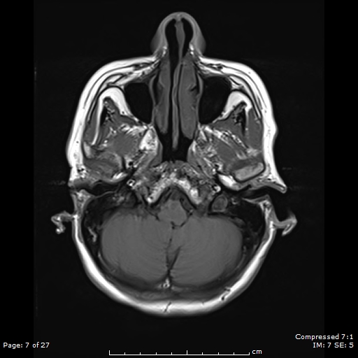 File:Anterior temporal lobe perivascular space (Radiopaedia 88283-104914 Axial T1 7).jpg