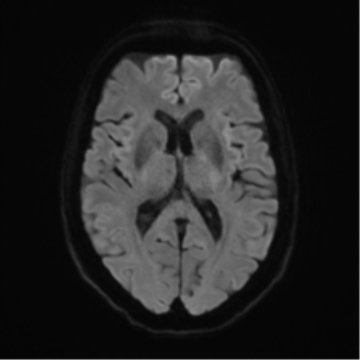 Anterior temporal pole cysts (Radiopaedia 46629-51102 Axial DWI 42).png