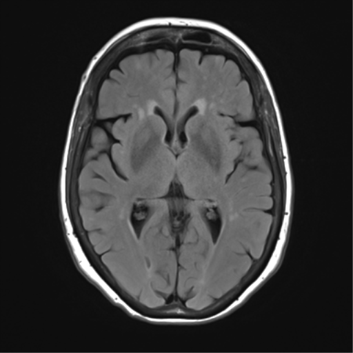 File:Anterior temporal pole cysts (Radiopaedia 46629-51102 Axial FLAIR 14).png