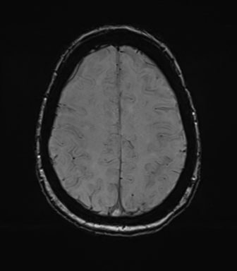 Anterior temporal pole cysts (Radiopaedia 46629-51102 Axial SWI 66).png