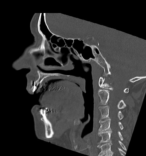 Anterior temporomandibular joint dislocation (Radiopaedia 59430-66784 B 27).jpg