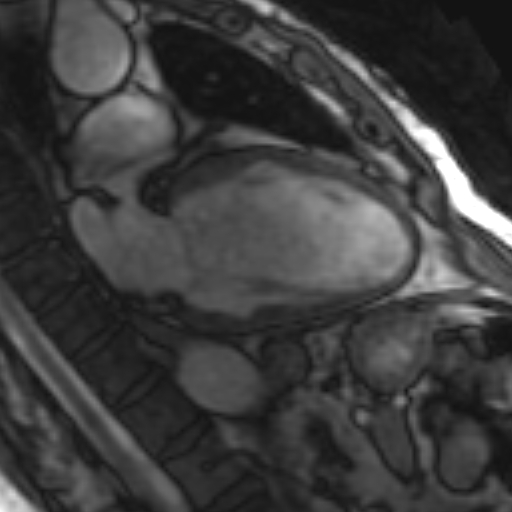 File:Anteroseptal hypokinesia after myocardial infarction (Radiopaedia 15978-15633 2 chamber view SSFE 28).jpg
