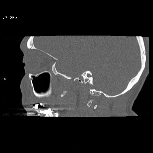 File:Antrochoanal Polyp (Radiopaedia 70510-80631 Sagittal bone window 16).jpg