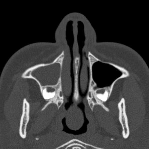 Antrochoanal polyp (Radiopaedia 33984-35202 Axial bone window 13).jpg