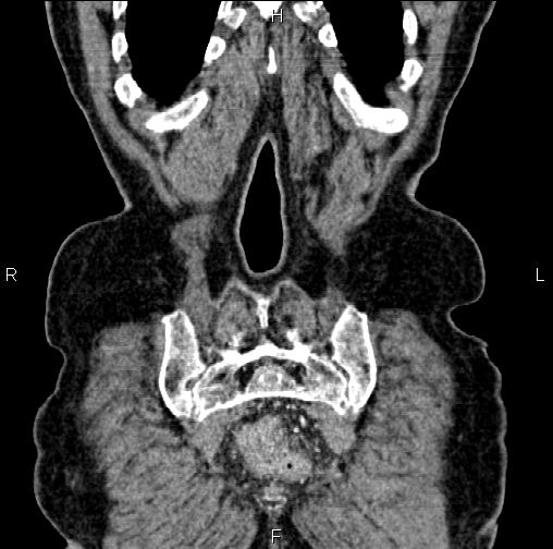 Aortic aneurysm and Lemmel syndrome (Radiopaedia 86499-102554 C 61).jpg