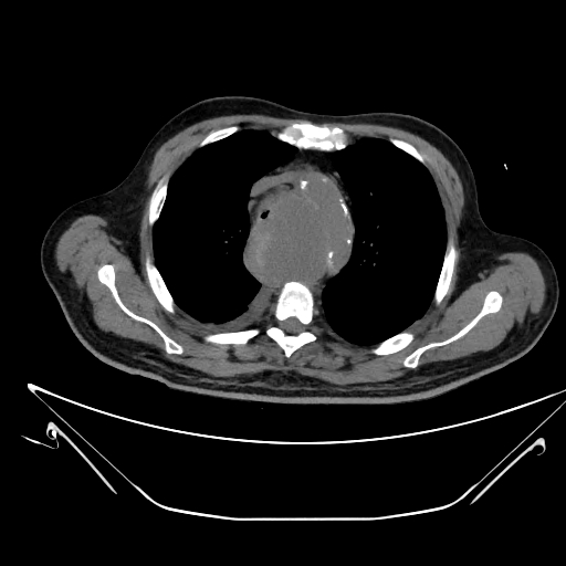 Aortic arch aneurysm (Radiopaedia 84109-99365 Axial non-contrast 89).jpg