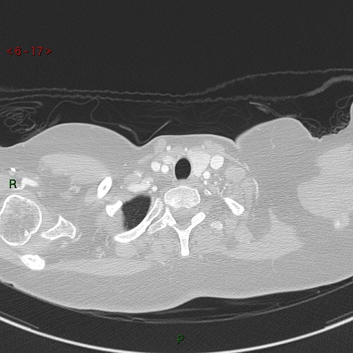 Aortic arch origin of left vertebral artery (Radiopaedia 51520-57286 Axial lung window 17).jpg