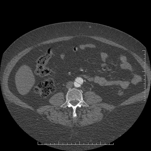 File:Aortic dissection- Stanford A (Radiopaedia 35729-37268 C 27).jpg
