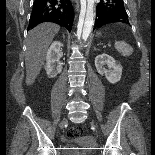 Aortic dissection- Stanford A (Radiopaedia 35729-37268 F 16).jpg