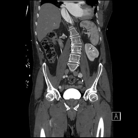 File:Aortic dissection (CTPA) (Radiopaedia 75506-86750 F 40).jpg