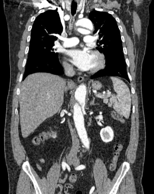 Aortic dissection (Radiopaedia 44411-48061 A 26).jpg