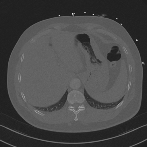 Aortic dissection (Radiopaedia 50763-56234 Axial bone window 90).png
