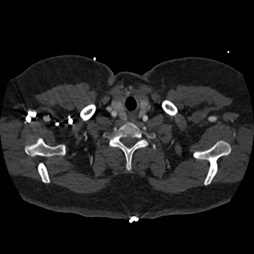 Aortic dissection (Radiopaedia 57969-64959 A 12).jpg