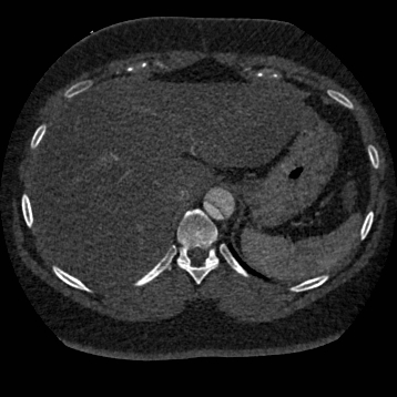 Aortic dissection (Radiopaedia 57969-64959 A 289).jpg