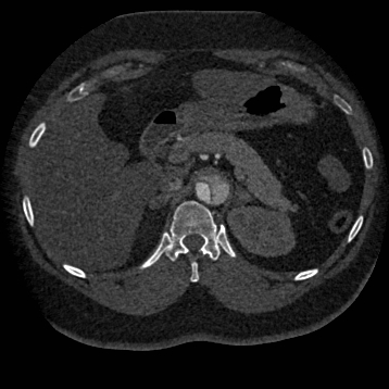 Aortic dissection (Radiopaedia 57969-64959 A 336).jpg