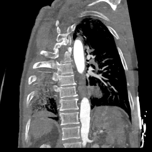 File:Aortic dissection - DeBakey type II (Radiopaedia 64302-73082 D 19).png