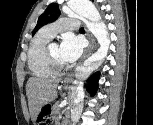 Aortic dissection - Stanford A -DeBakey I (Radiopaedia 28339-28587 C 44).jpg