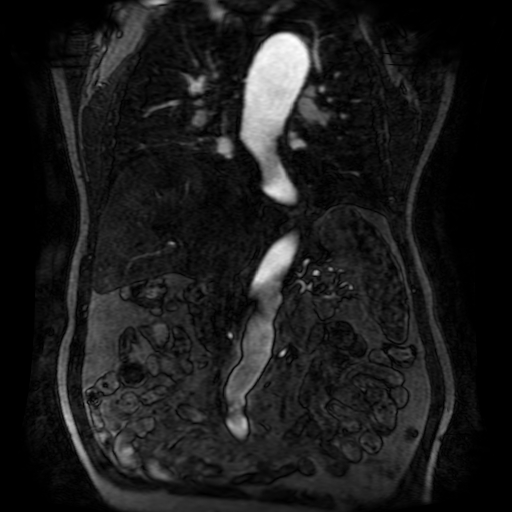 Aortic dissection - Stanford A - DeBakey I (Radiopaedia 23469-23551 D 127).jpg
