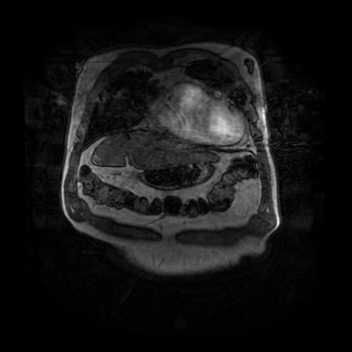 File:Aortic dissection - Stanford A - DeBakey I (Radiopaedia 23469-23551 D 24).jpg