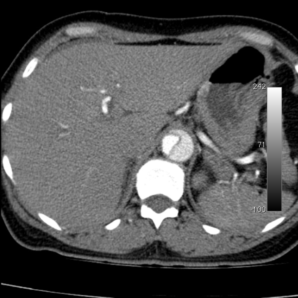 Aortic dissection - Stanford type A (Radiopaedia 29247-29659 A 73).jpg