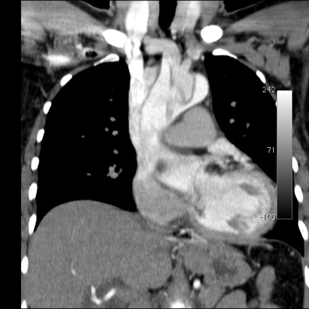 Aortic dissection - Stanford type A (Radiopaedia 29247-29659 B 27).jpg