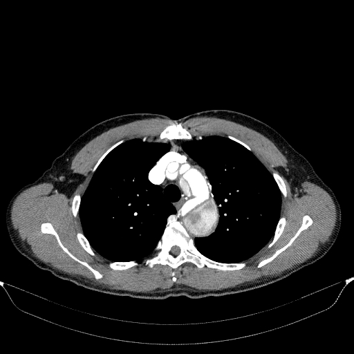 File:Aortic dissection - Stanford type A (Radiopaedia 83418-98500 A 19).jpg