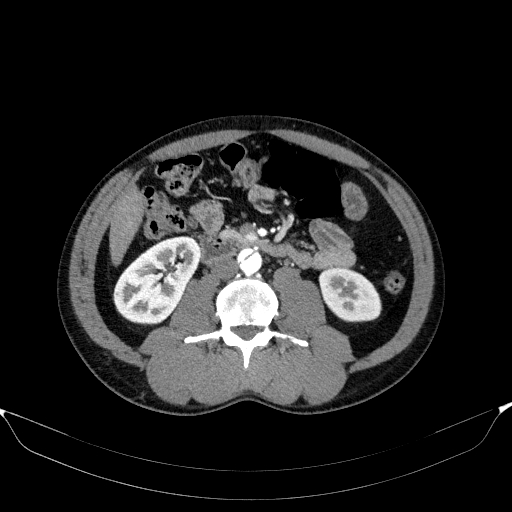 Aortic dissection - Stanford type A (Radiopaedia 83418-98500 A 80).jpg