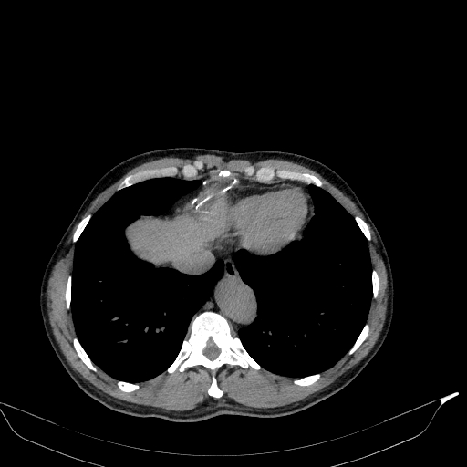 Aortic dissection - Stanford type A (Radiopaedia 83418-98500 Axial non-contrast 35).jpg