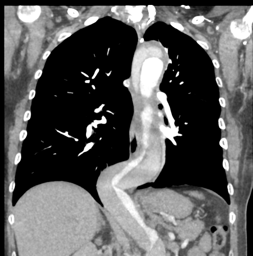 File:Aortic dissection - Stanford type B (Radiopaedia 50171-55512 B 50).png