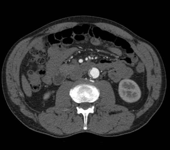 File:Aortic dissection - Stanford type B (Radiopaedia 73648-84437 A 161).jpg