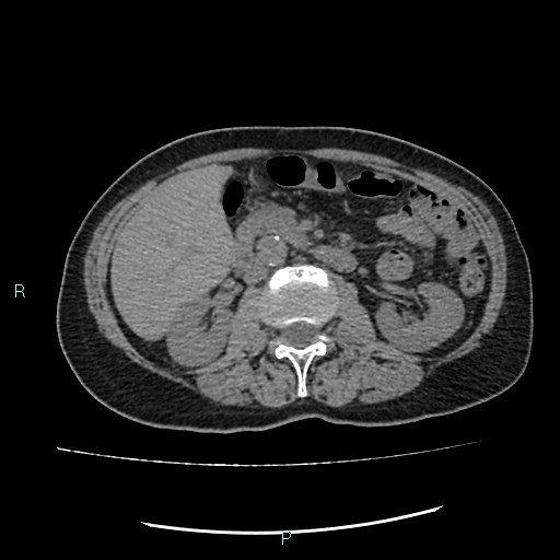 File:Aortic dissection extended to lusory artery (Radiopaedia 43686-47136 Axial non-contrast 35).jpg