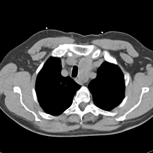 File:Aortic intramural hematoma (Radiopaedia 31139-31838 Axial non-contrast 11).jpg