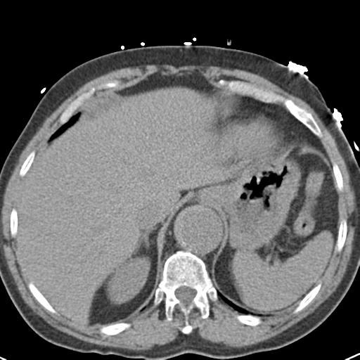 Aortic intramural hematoma (Radiopaedia 31139-31838 Axial non-contrast 47).jpg