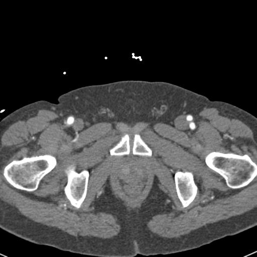 Aortic intramural hematoma (Radiopaedia 31139-31838 B 173).jpg